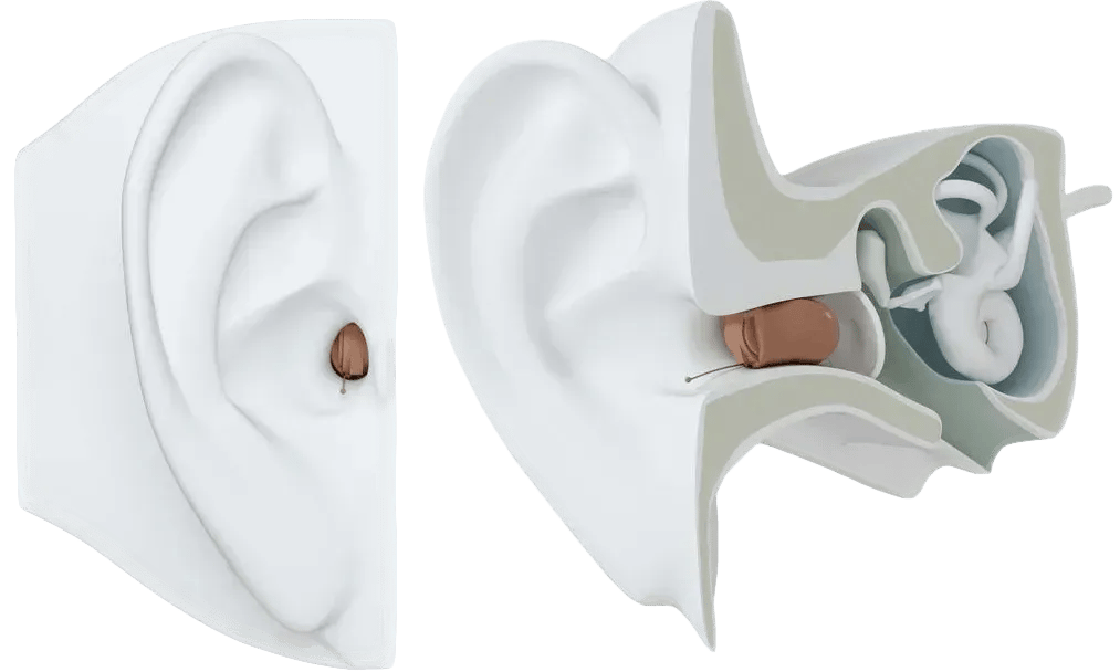 Hearing aid product visual representing direct-to-consumer hearing devices.
